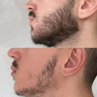 رویش مجدد مو و ریش (اکسونیک)