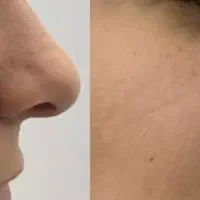 کوچک شدن بینی توی ۲۰روز