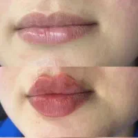 تخفیف بهاره ژل و بوتاکس، انزیم، فیلر،