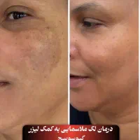 لیزر|خدمات آرایشگری و زیبایی|همدان, |دیوار