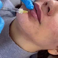 مدل رایگان تزریق بوتاکس و ژل
