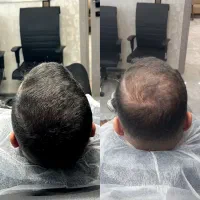 میکرو اسکالپ(رفع کم پشتی مو)