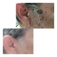 برداشتن خالهای گوشتی و سطحی