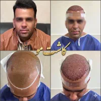 کاشت مو ابرو ریش با شرایط ویژه