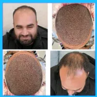 کاشت مو و کاشت ابرو تضمینی با جدید ترین متدهای روز