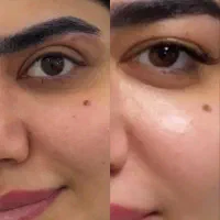مدل جراحی لیفت ابرو
