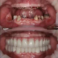 ایمپلنت دیجیتال و یک روزه