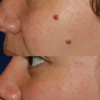 درمان ۱۴ روزه زگیل ویروس HPV