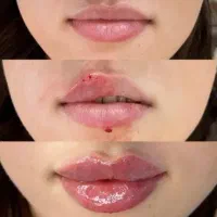 تزریق ژل و بوتاکس فیلر مزوژل جوانساز