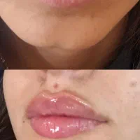 تخفیف محدود ژل بوتاکس ساکشن