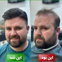 پروتز مو با شرایط پرداخت ۳۰٪ نقد مابقی چک