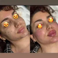 تزریق ژل بوتاکس برای خانماآقایان باقیمت باورنکردن
