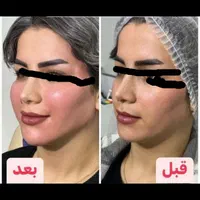 آموزش فوق تخصصی ژل وبوتاکس