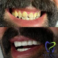 خدمات دندانپزشکی لمینت و کامپوزیت زیبایی