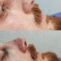 عمل بینی تیپ پلاستی و بلفارو