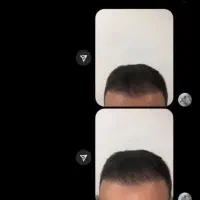 کاشت مو پرتراکم با تضمین کتبی نقد اقساط|خدمات آرایشگری و زیبایی|ساری, |دیوار