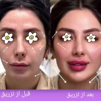 بوتاکس رایگان با تزریق ۲ سی سی ژل ( فیلر)