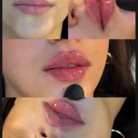 تزریق فیلر اودری کره 690 و بوتاکس مصپورت 500