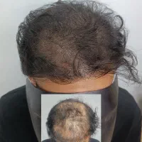 اولین مرکز میکرواسکالپ بروجرد
