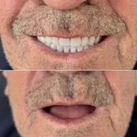 دندانپزشکی دندانسازی اقساطی یک روزه در شهر ساوه