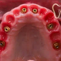 ایمپلنت توسط متخصص فک و صورت / +3000کاشت موفق