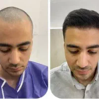 جشنواره کاشت مو و ابرو با تخفیف ۲۵ درصدی