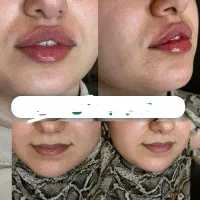 جشنواره تزریق ژل لب گونه زاویه سازی بوتاکس ...