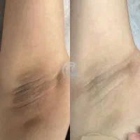 لیزر موهای زائد فول بادی ۸۹۰ ضمانت بازگشت وجه