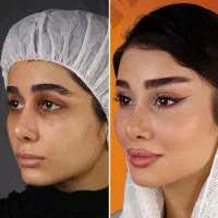 کانتورینگ فیس فیلربادی غبغب ابرو بینی باسن ژل سینه