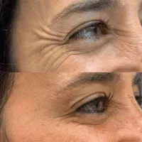 بوتاکس تخصصی صورت میگرن زیربغل کف دست و پا