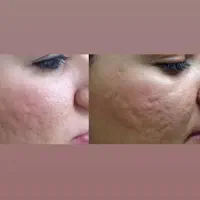 پاکسازی فیشیال باپیشرفته ترین دستگاها