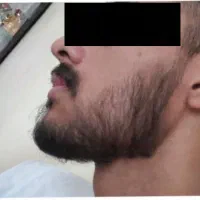 معجزه رشد ریش و سبیل