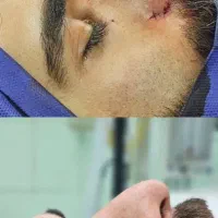 عمل زیبایی بینی،با تخفیف ویژه تابستونی