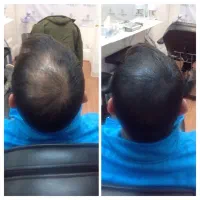 با کچلی خداحافظی کن