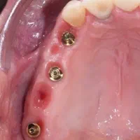 جشنواره ویژه دندانپزشکی و ایمپلنت  اقساط بلند مدت
