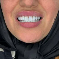 کامپوزیت ۶ تومن