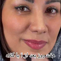 معجزه بلفاروپلاستی نیولایف