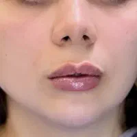 مدل رایگان فیلر لب و لیفت با نخ
