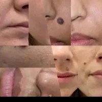 خال برداری  و زگیل