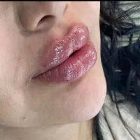 آفر ویژه ژل.مزوجوانسازی.بوتاکس چشم گربه ای