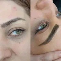 فیبروز،میکروبلیدینگ،شیدلب
