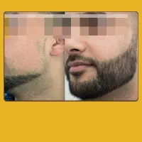 ریش ریشه مرده