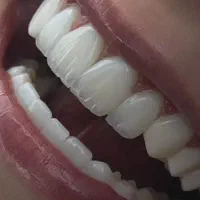 کامپوزیت مدل/دندانپزشکی/لمینت/دندان مصنوعی/اقساط