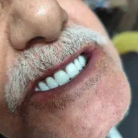 دندان مصنوعی هر فک ۶ تومان ضمانتی