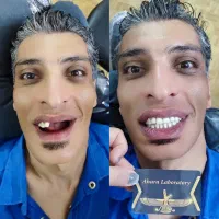 لابراتوار دندانسازی اهورا،دندان مصنوعی