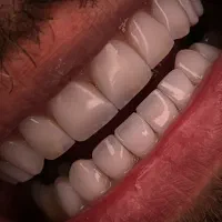 کامپوزیت دندان لبه شفاف لایرینگ