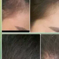 پک پوست مو