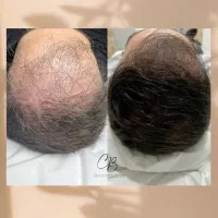 تا اینو ندیدی کاشت مو نکن
