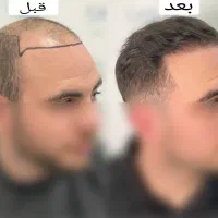 کاشت رایگان تبریز