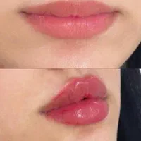 فیشال مزو فیلر بوتاکس نخ تخصصی